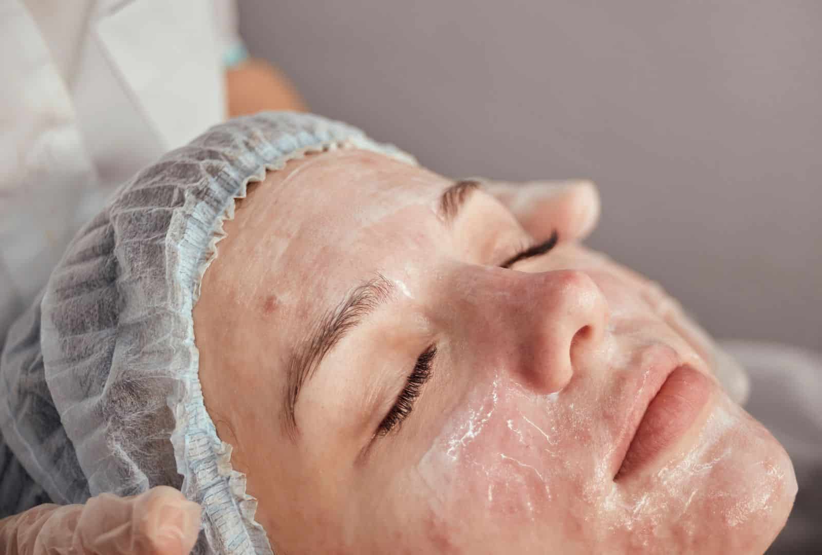 טיפול באקנה לנשים בבאר שבע