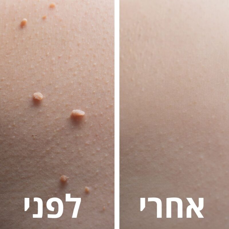 לפני ואחרי