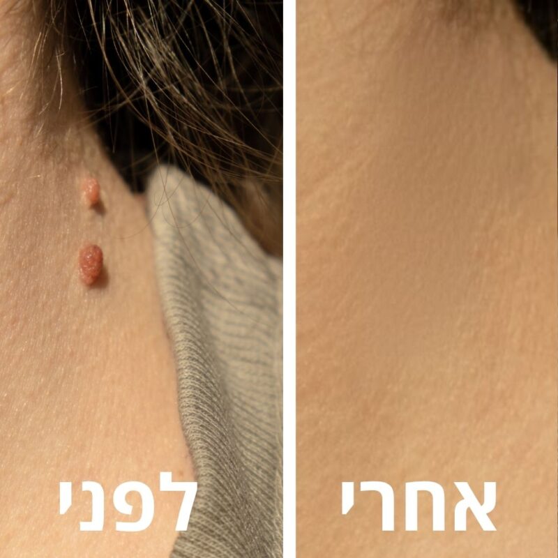 לפני ואחרי