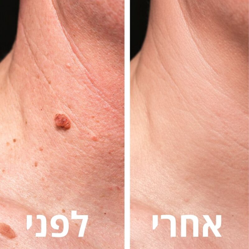לפני ואחרי