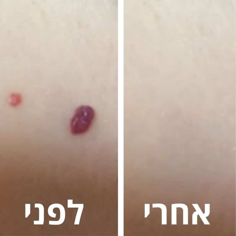 לפני ואחרי